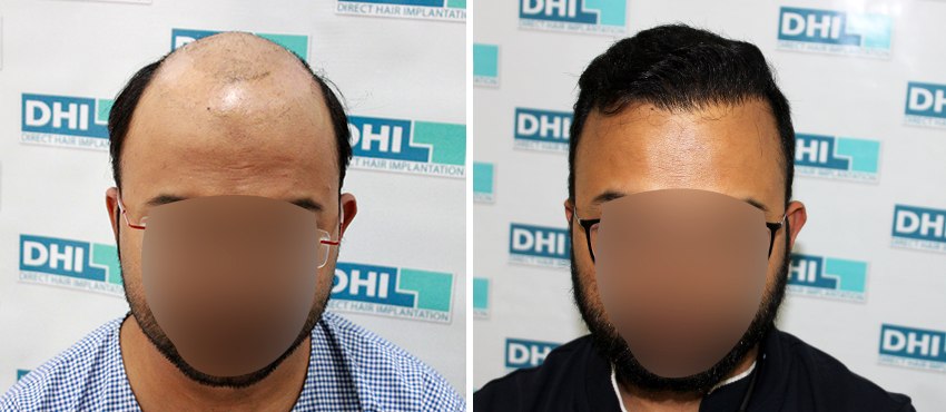 DHI before & after hair transplant results